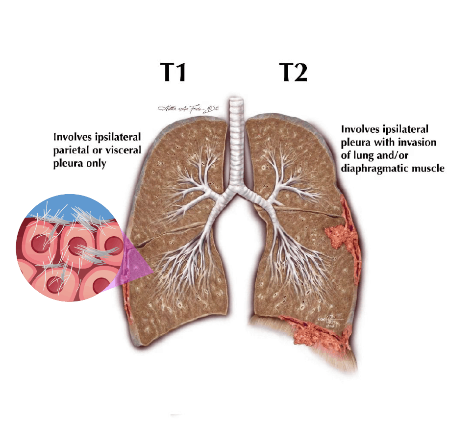 kanker mesothelioma